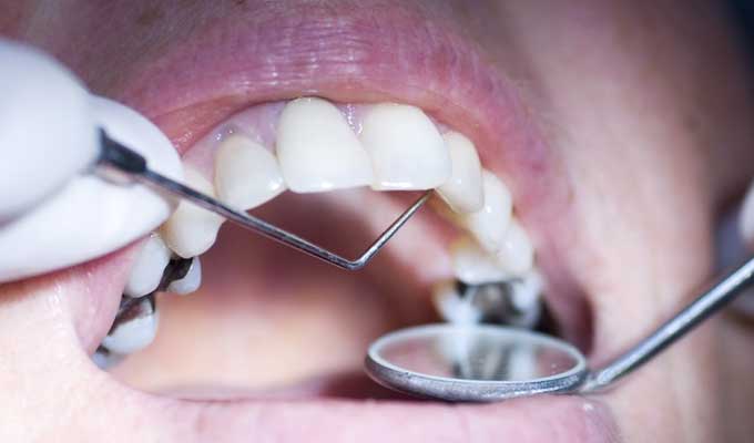 وزارة الصحّة تمنع استعمال ملغم الأسنان في علاج الأسنان، عند الأطفال دون سن الخامسة عشرة والنساء الحوامل والمرضعات